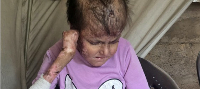 ريما طفلة من غزة تعاني من انحلال البشرة الفقاعي، أو "مرض الفراشة"، مرض نادر يجعل جلدها هشّاً إلى حد أن أبسط احتكاك قد يسبب لها جروحاً مفتوحة ومؤلمة.